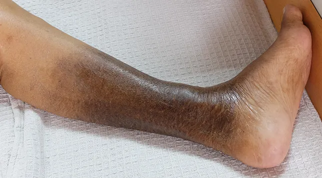 memahami-kesehatan-chronic-venous-insufficiency-dan-penanganannya