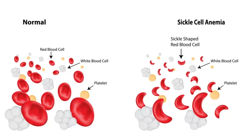 memahami-kesehatan-dan-dampak-anemia-sel-sabit-pada-tubuh