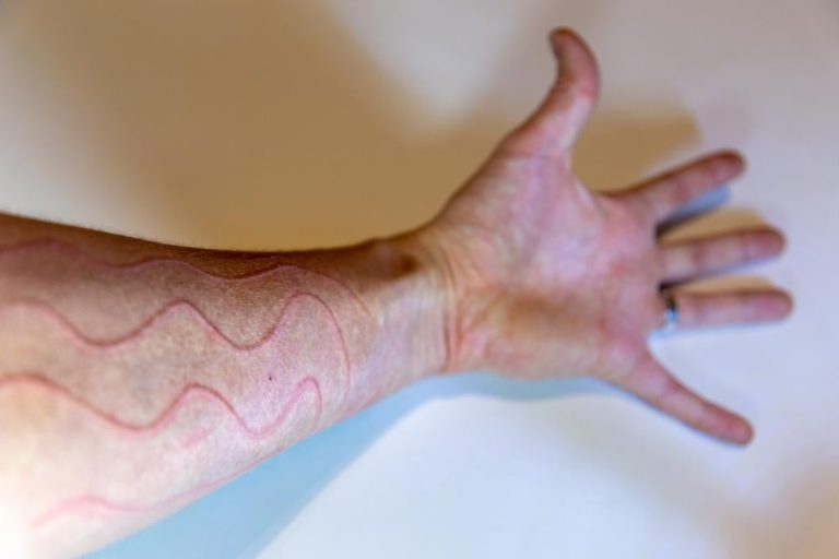 memahami-kesehatan-dermatographia-gejala-dan-penanganannya