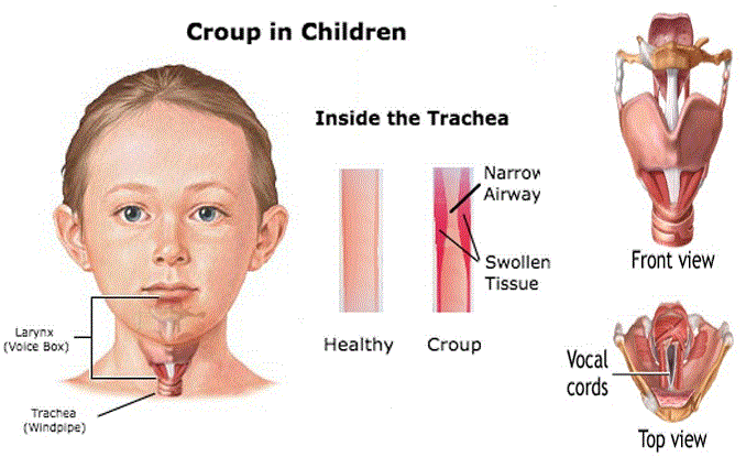 mengenal-kesehatan-croup-gejala-penyebab-dan-penanganannya