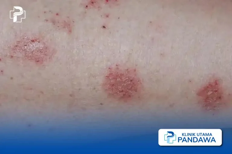 mengenal-kesehatan-dan-penanganan-dermatitis-numularis