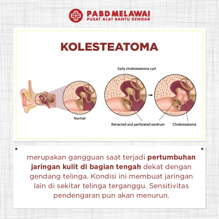mengenal-kesehatan-dan-penanganan-kolesteatoma-telinga