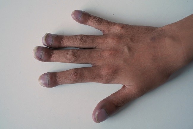 mengupas-penyebab-dan-gejala-kesehatan-clubbing-finger