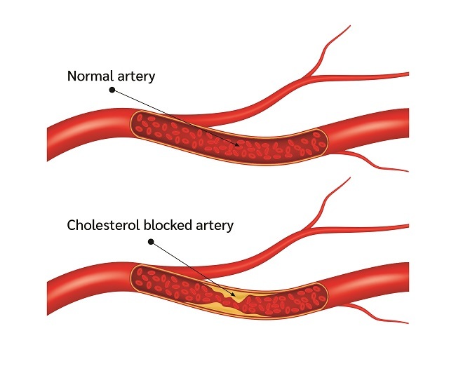 pemahaman-kesehatan-dan-pencegahan-aterosklerosis