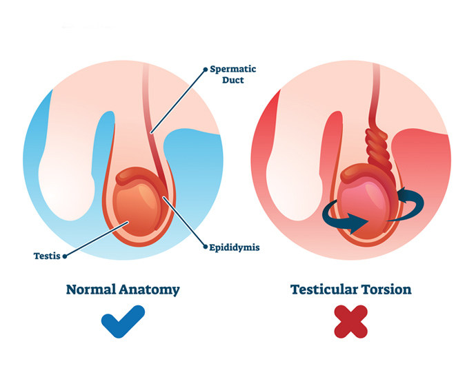 pemahaman-kesehatan-torsio-testis-dan-gejalanya