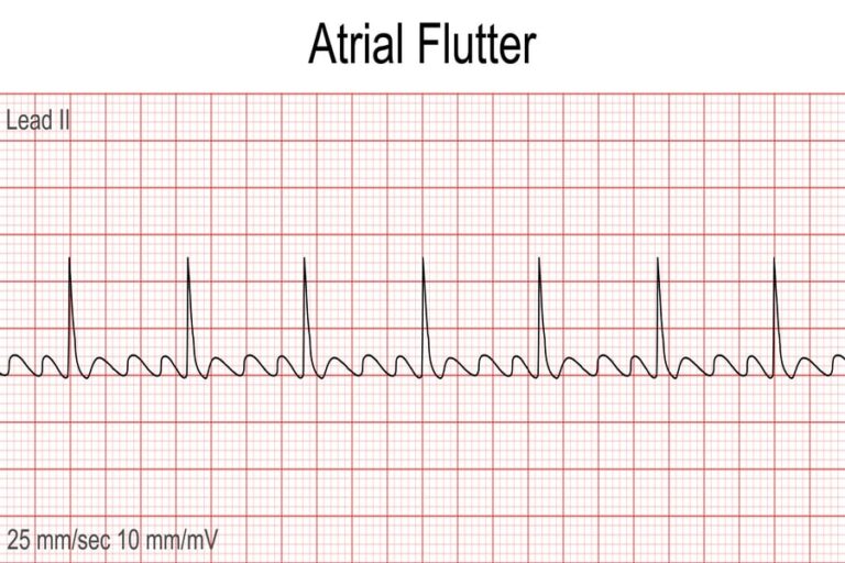 pemahaman-mendalam-mengenai-kesehatan-atrial-flutter