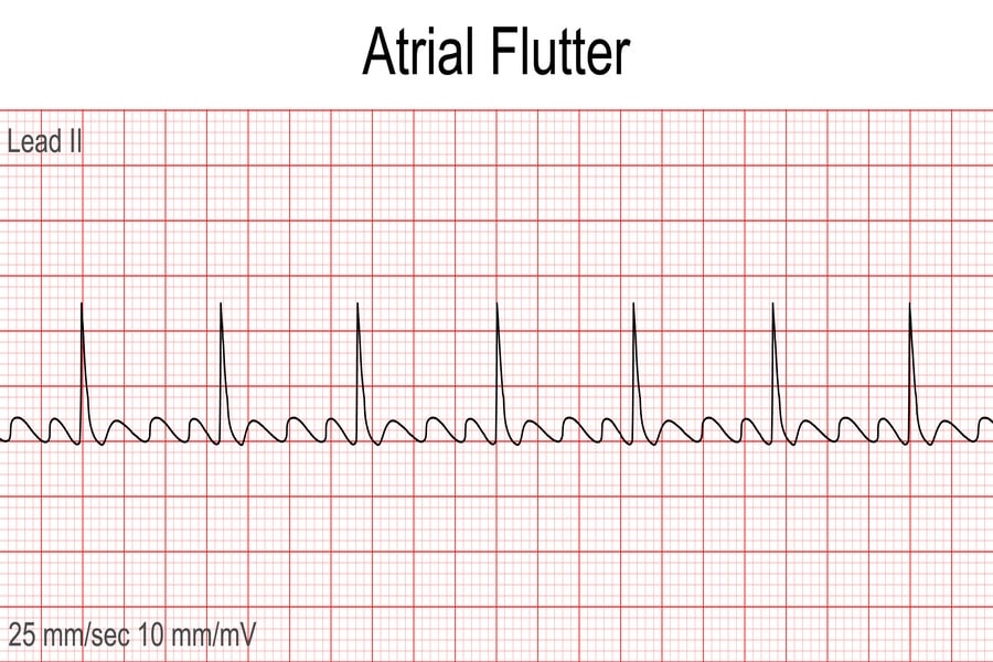 pemahaman-mendalam-mengenai-kesehatan-atrial-flutter