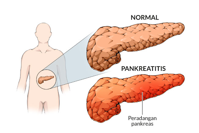 pemahaman-mendalam-mengenai-pankreatitis-kronis
