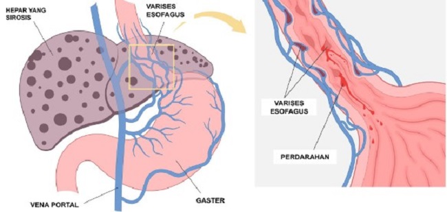 pemahaman-mendalam-tentang-varises-esofagus