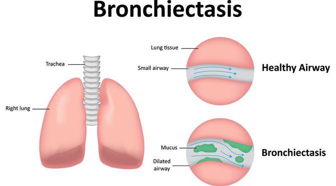 pemahaman-tentang-penyakit-bronkiektasis