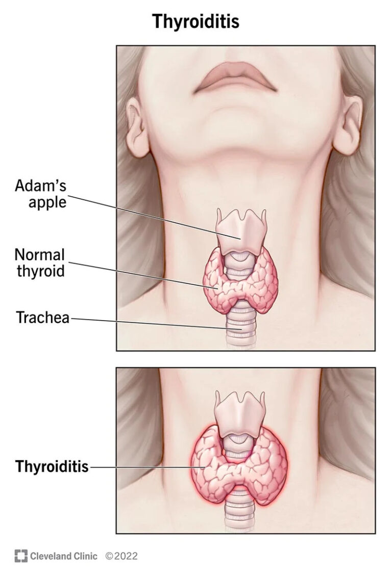 pemahaman-tentang-tiroiditis-akut-gejala-penyebab-dan-pengobatan