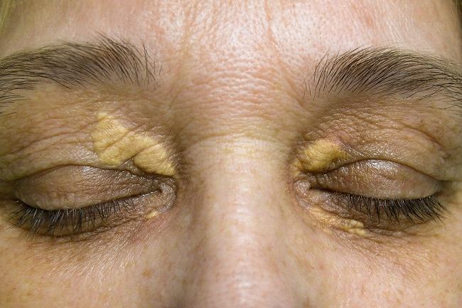 pengenalan-dan-penanganan-xanthelasma