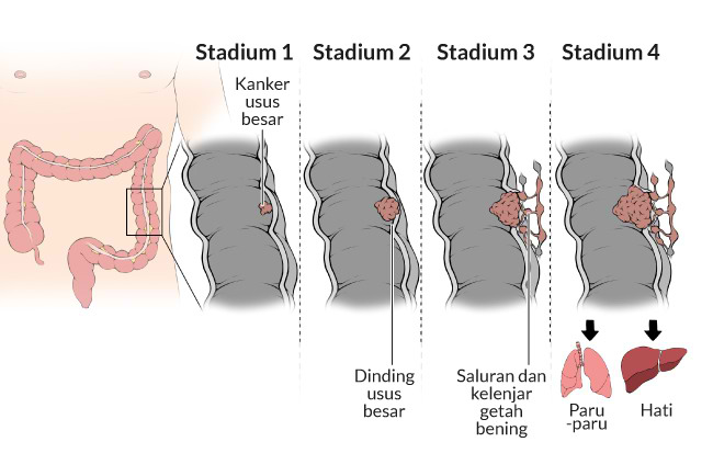 pengetahuan-penting-tentang-kesehatan-kanker-usus-besar
