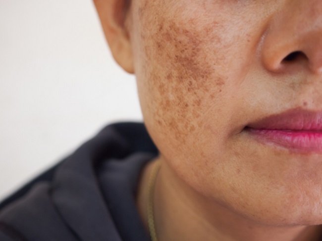 penjelasan-tentang-penyakit-xeroderma-pigmentosum
