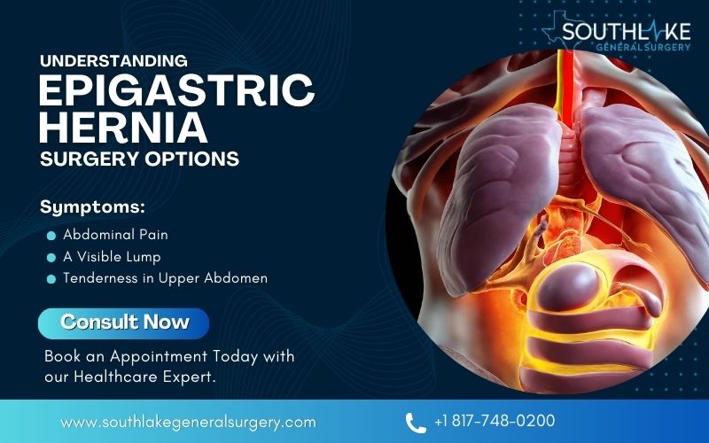 pentingnya-memahami-hernia-epigastrik