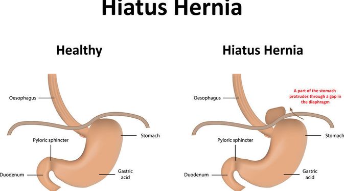 pentingnya-memahami-hernia-hiatus-penyebab-dan-penanganan