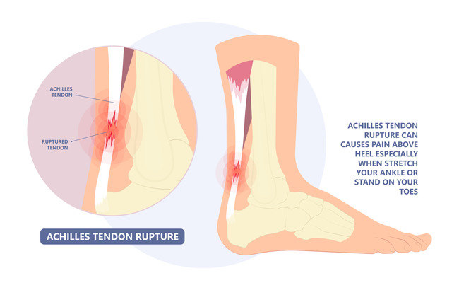 pentingnya-mengetahui-ruptur-tendon-achilles