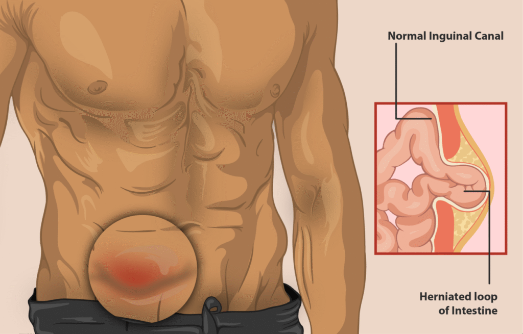 pentingnya-mengetahui-tentang-hernia