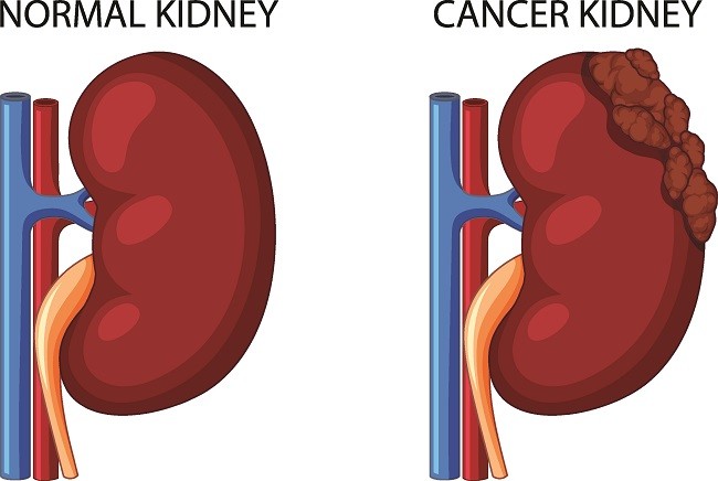 pentingnya-mengetahui-tentang-tumor-ginjal