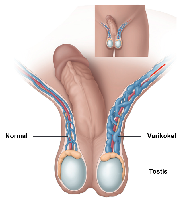 pentingnya-menjaga-kesehatan-varikokel