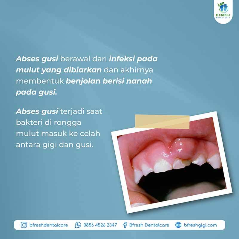 pentingnya-perawatan-abses-gigi