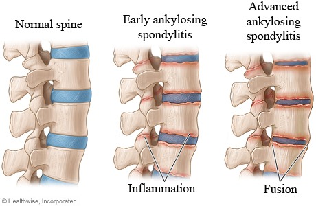 pentingnya-perawatan-untuk-ankylosing-spondylitis