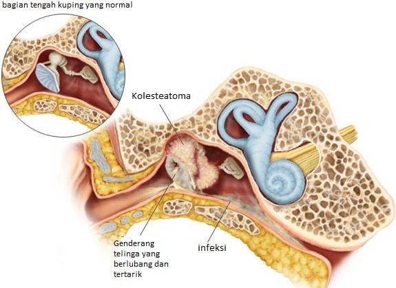 penyakit-kolesteatoma-pengertian-gejala-dan-pengobatan