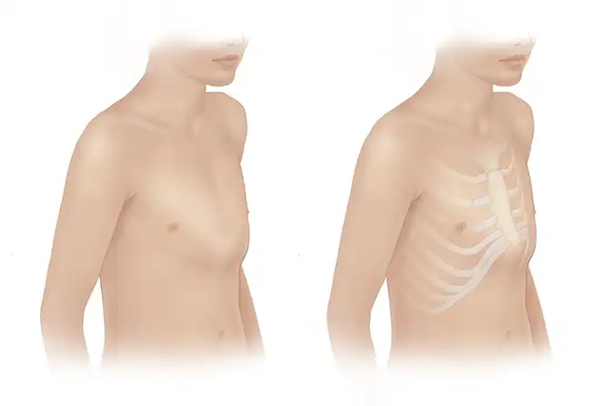 penyebab-dan-pengobatan-pectus-carinatum