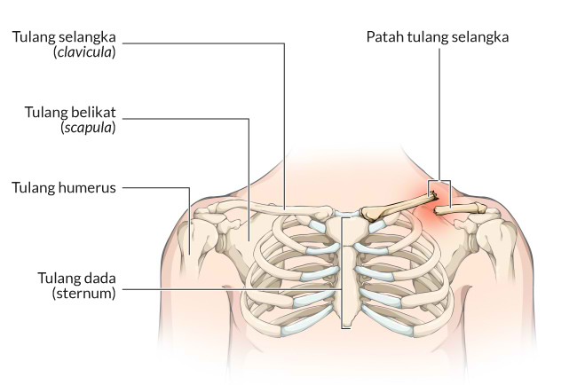 penyebab-gejala-dan-pengobatan-patah-tulang-selangka