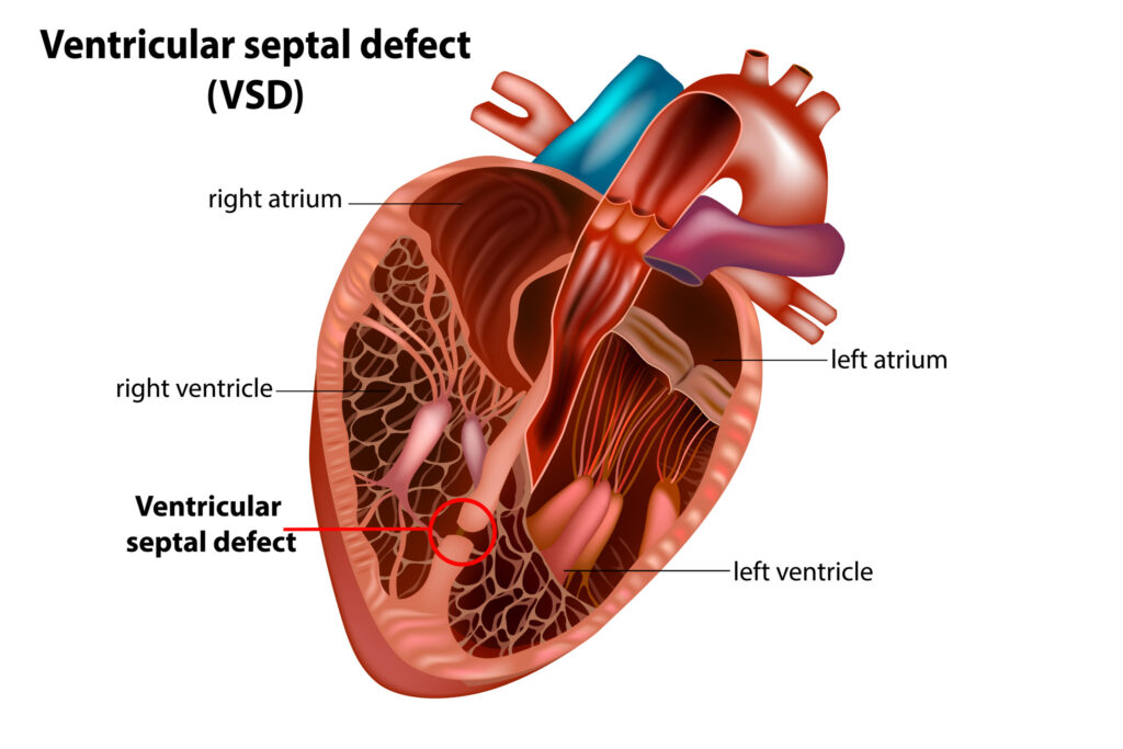 segala-yang-perlu-anda-ketahui-tentang-ventricular-septal-defect