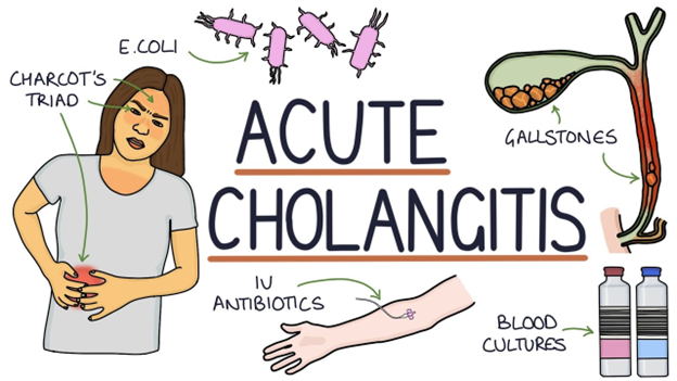 understanding-cholangitis-causes-symptoms-and-treatment-options