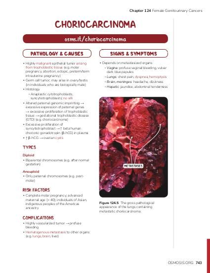 understanding-choriocarcinoma-causes-symptoms-and-treatment-options