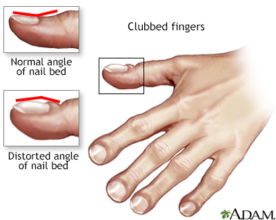 understanding-clubbing-finger-causes-symptoms-and-treatments