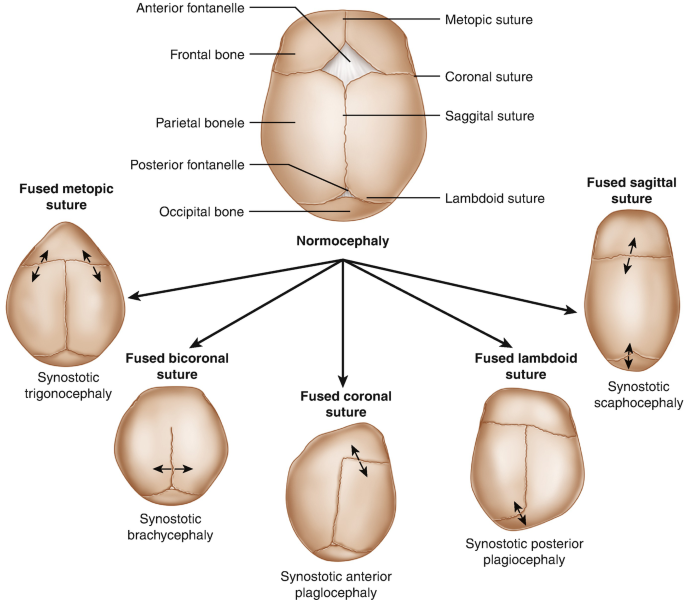 understanding-craniosynostosis-causes-symptoms-and-treatments