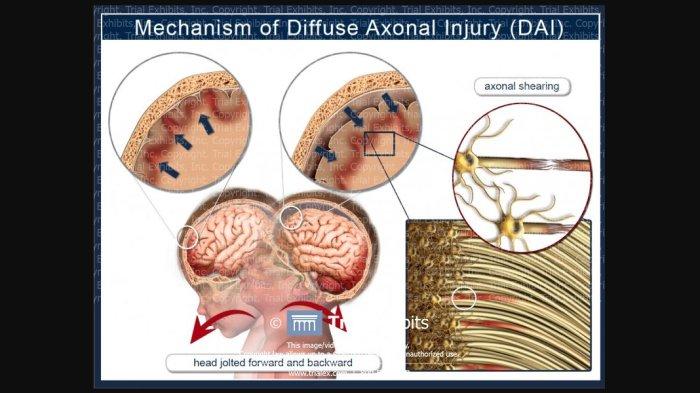 kesehatan-dan-dampak-diffuse-axonal-injury-pada-otak