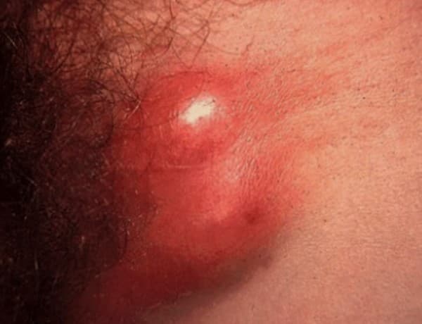 kesehatan-dan-gejala-lymphogranuloma-venereum-lgv