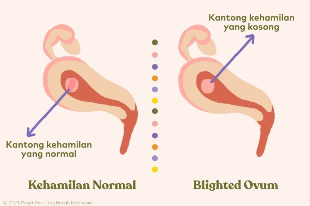 kesehatan-dan-pemahaman-tentang-blighted-ovum-dalam-kehamilan