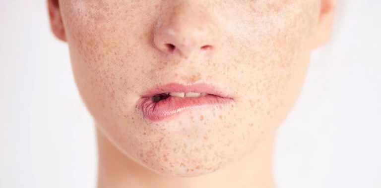 kesehatan-dan-penanganan-xeroderma-pigmentosum-secara-lengkap
