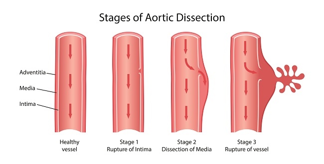 kesehatan-diseksi-aorta-penyebab-gejala-dan-pengobatan