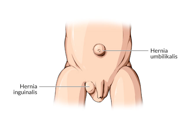 kesehatan-hernia-inguinalis-gejala-penyebab-dan-pengobatan
