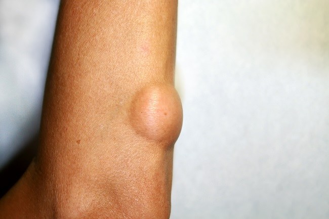 kesehatan-liposarcoma-penyakit-tumor-lemak-yang-perlu-diketahui