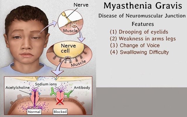 kesehatan-myasthenia-gravis-gejala-penyebab-dan-penanganan