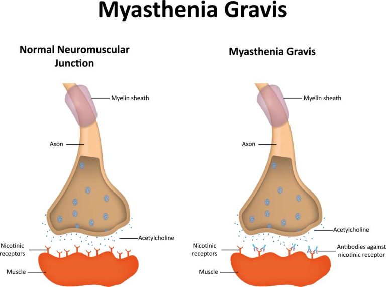 kesehatan-myasthenia-gravis-gejala-penyebab-dan-pengobatan