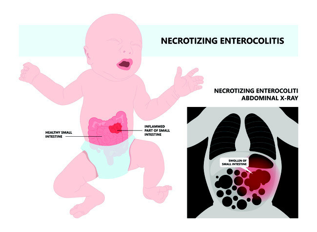 kesehatan-necrotizing-enterocolitis-penyakit-usus-pada-bayi-baru-lahir