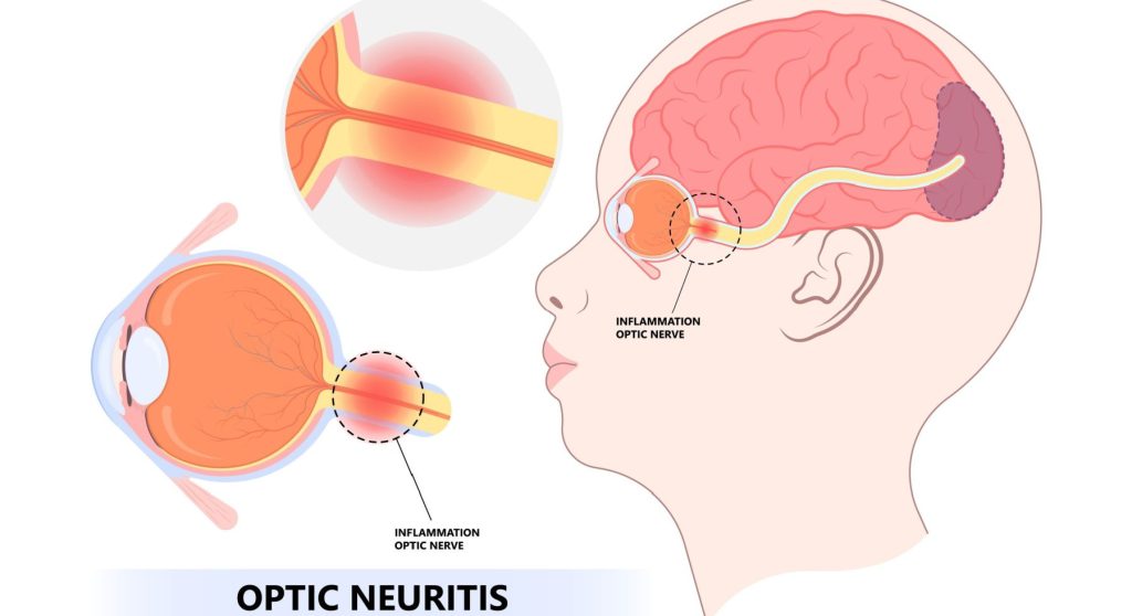 kesehatan-neuritis-optik-penyebab-gejala-dan-pengobatannya