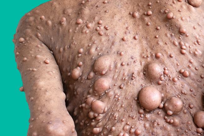 kesehatan-neurofibromatosis-tipe-2-gejala-penanganan-dan-pencegahan