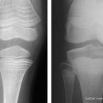 kesehatan-osteogenesis-imperfecta-pengetahuan-dan-perawatan-terbaru