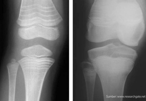 kesehatan-osteogenesis-imperfecta-pengetahuan-dan-perawatan-terbaru