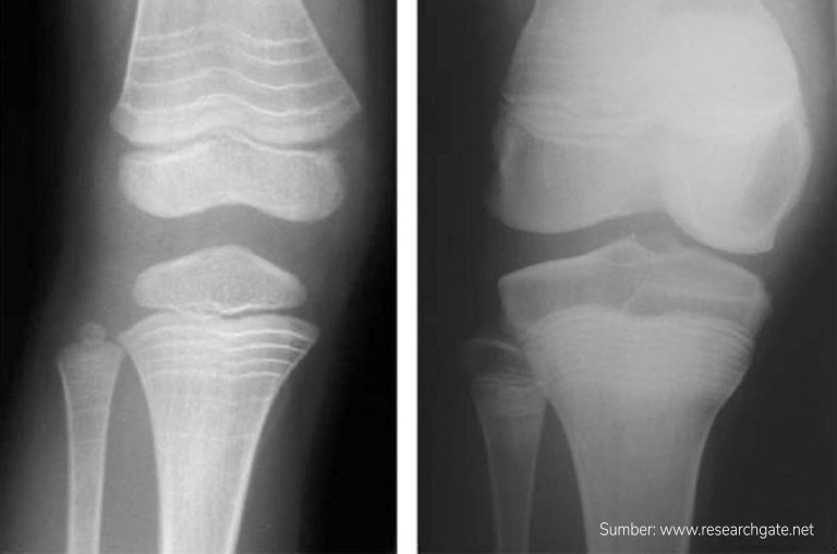 kesehatan-osteogenesis-imperfecta-pengetahuan-dan-perawatan-terbaru