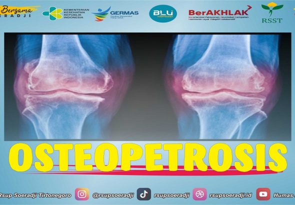 kesehatan-osteopetrosis-gejala-penyebab-dan-penanganannya